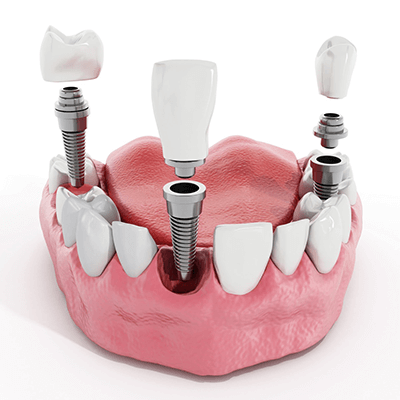 Dental Implants Youngstown