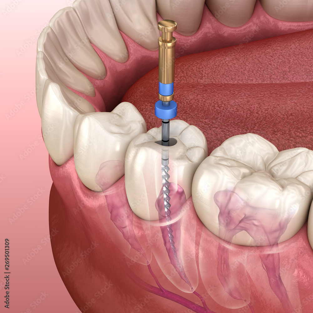 Root Canal Youngstown