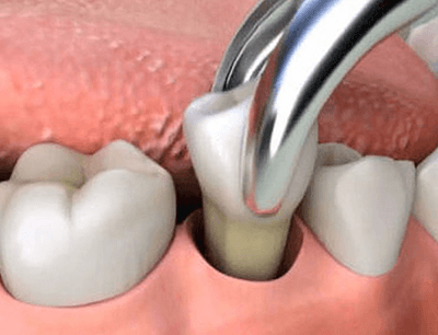 Dental Extractions Youngstown